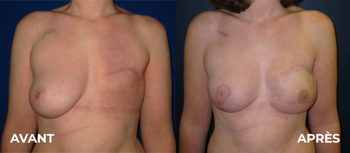 Photo avant après d'implants mammaires