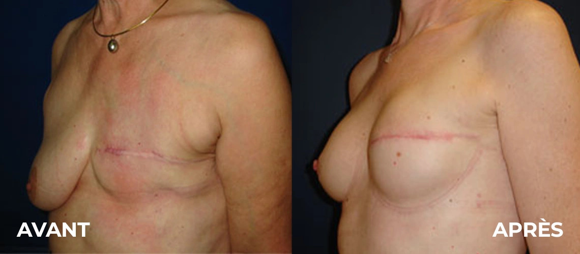 Photo avant après d'implants mammaires